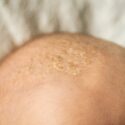 seboroická dermatitida