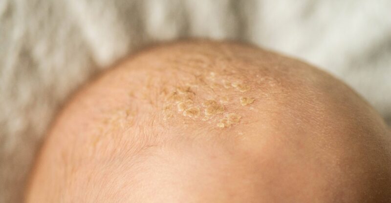 seboroická dermatitida